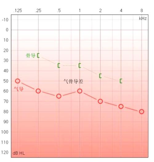 耳声阻抗检测异常的严重性