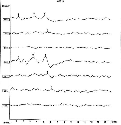 新生儿42天abr检测65详解