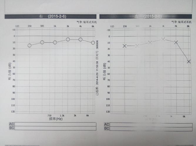 听力检测是评估个体听力水平的重要手段，听力图中的X和O是解读听力测试结果的关键符号。在听力学领域，对这些符号的正确理解至关重要，因为它们直接关联到听力损失的诊断和治疗。本文将详细解释这些符号的含义及其在听力评估中的应用。